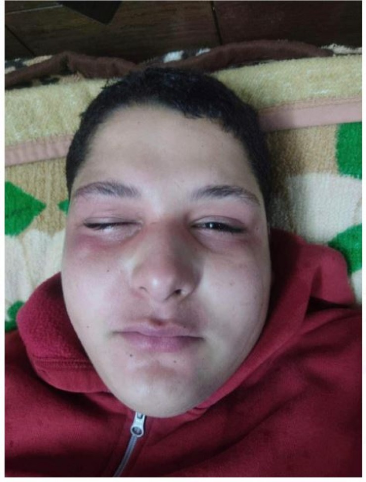 إصابة طفل بحروق بعد اعتداء مستوطن عليه بغاز الفلفل في حوارة 