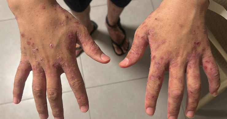 انتشار متسارع للجرب في السجون.. نادي الأسير يكشف واقعًا صحيًا صادمًا للأسرى