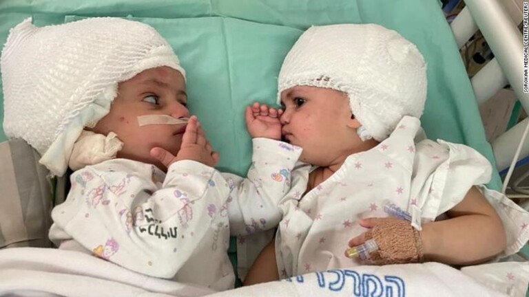 نجاح أول عملية في إسرائيل لفصل توأم ملتصق الرأس