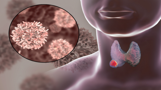 ما هي علامات الإصابة بسرطان الغدة الدرقية وهل يمكن علاج المرض؟
